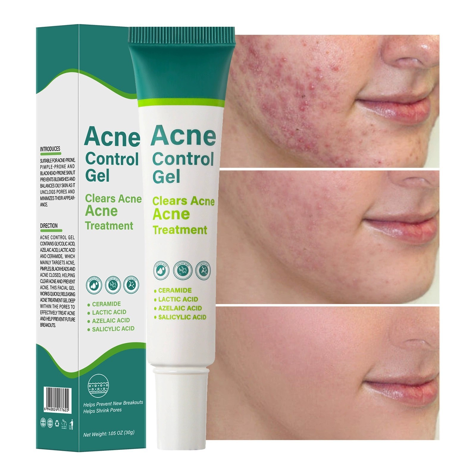 Acne Cream For Face Pimples Remover Treatment Shrink Pores Oil Control Lighten Acne Marks Whitening Smoothing Facial Skin Care