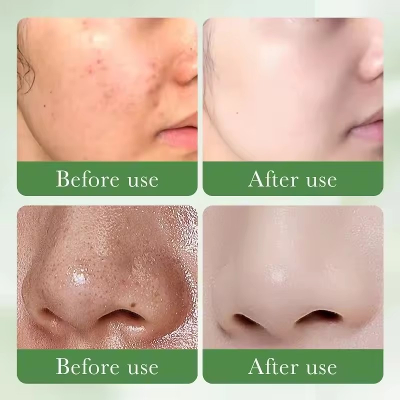 Salicylic Acid Acne Removing Facial Cleanser Natural Herbs Deep Cleaning Pores Oil Control Lighten Acne Moisturizing Skin Care