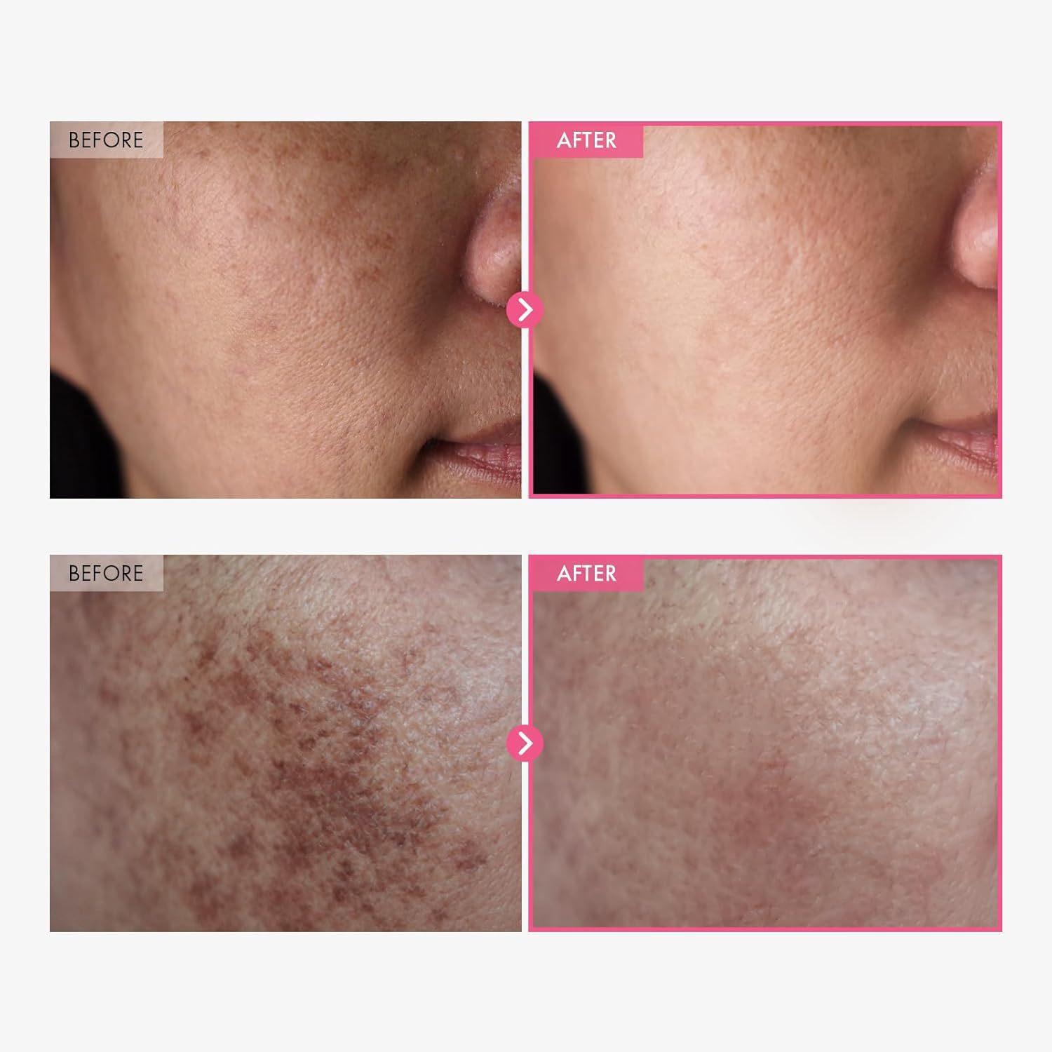 Arbutin7% Tranexamic Acid 4% Cream