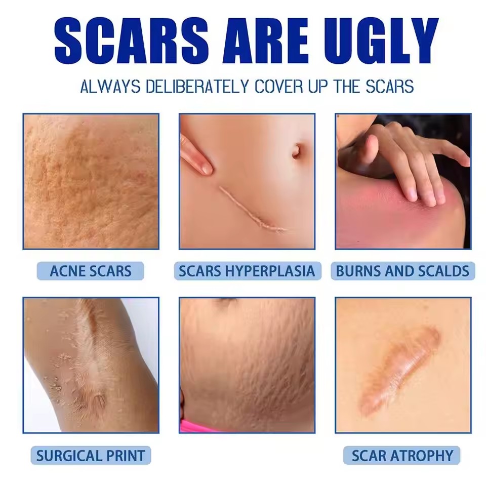 Centella Asiatica Scar Removal Cream Rapid Repair of New Old Scars,Spots,Burns All Natural Treatment with Shea Butter