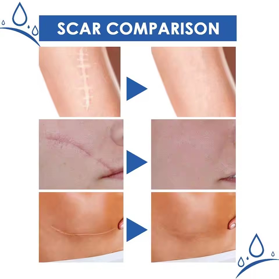 Centella Asiatica Scar Removal Cream Rapid Repair of New Old Scars,Spots,Burns All Natural Treatment with Shea Butter