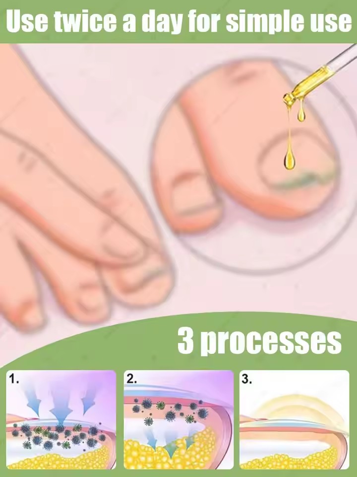 2026 new nails become translucent and fungal free