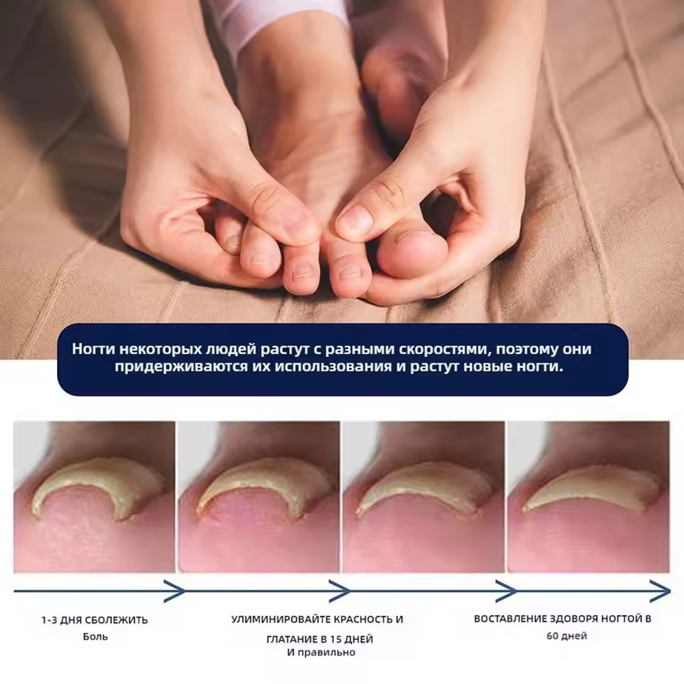 2026 new nails become translucent and fungal free